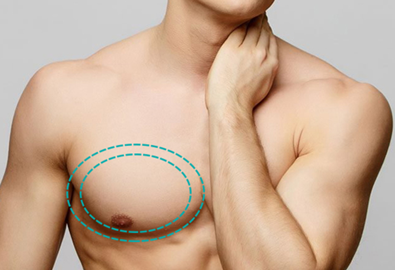 How is Gynecomastia Different from Chest Fat?