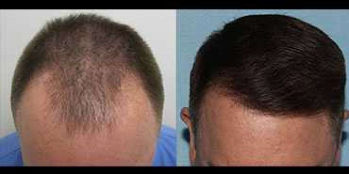 Do Hair Transplants Change The Texture Of Your Hair?