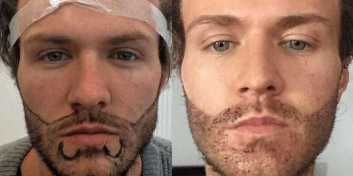 Beard Transplant Before and After