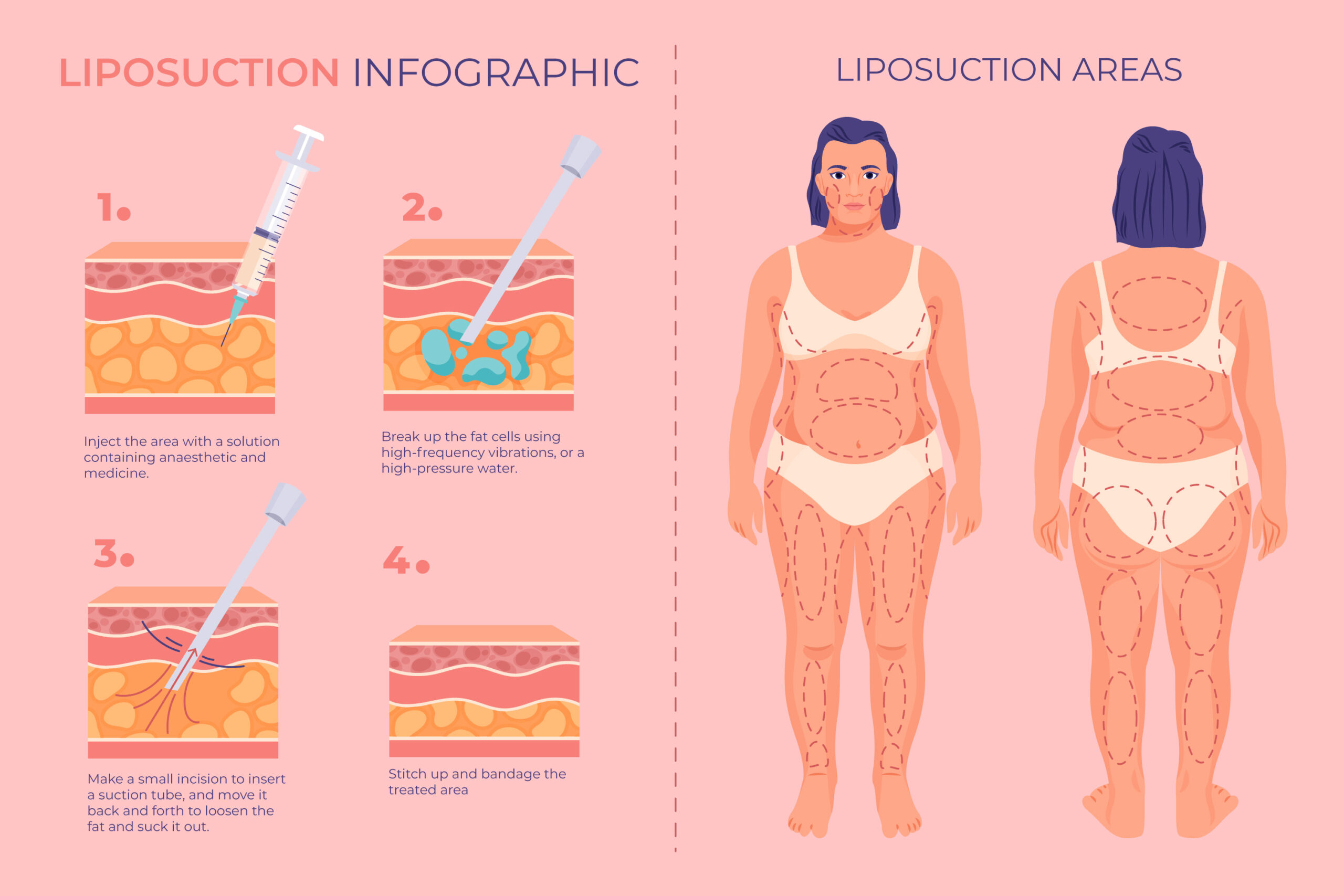 Liposuction: How It Works, Benefits, Types, and More! Update 2022