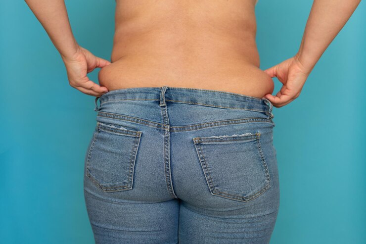 Get Rid of Back Fat Once and For All with Liposuction