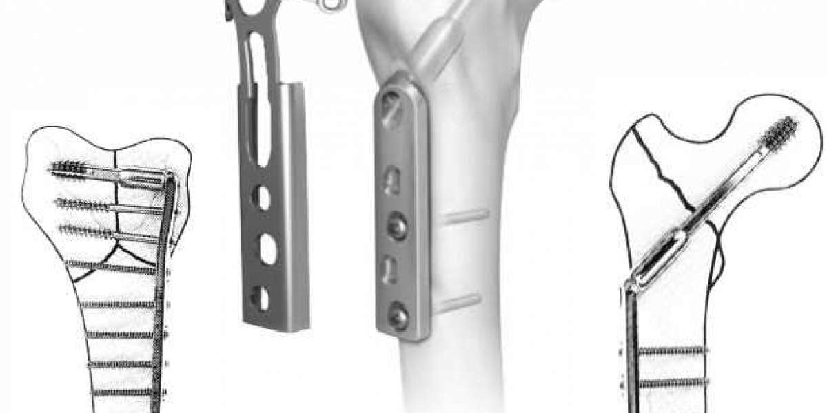 The Best Orthopedic Implants Company