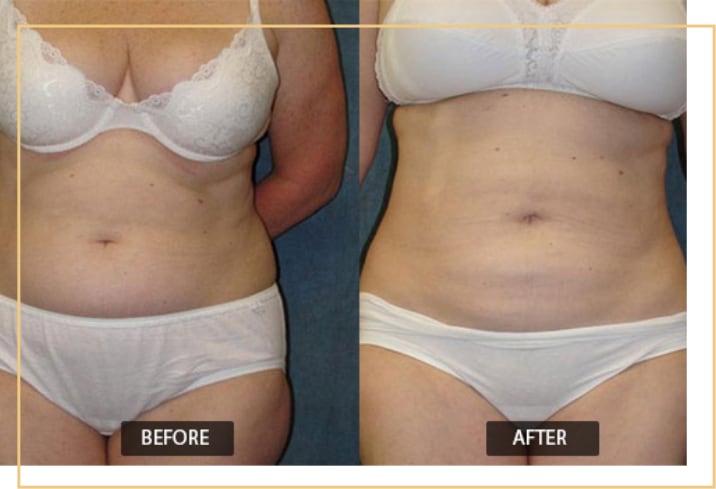 Complete Guide to Liposuction: FAQs to Help You