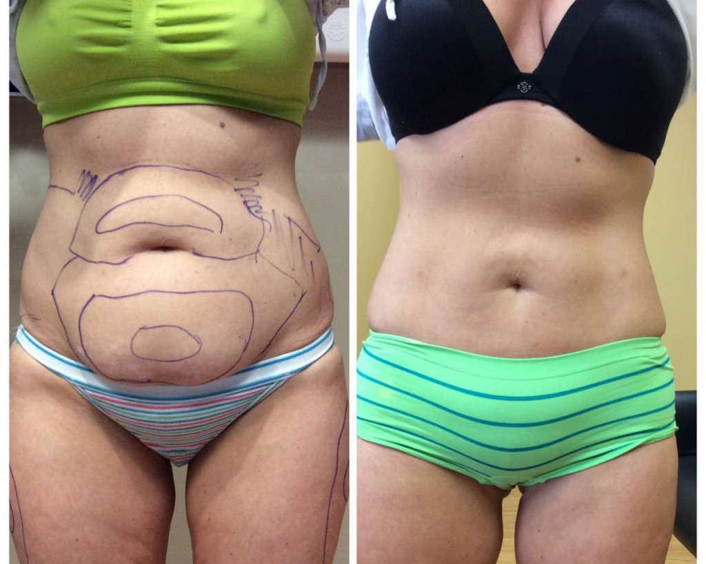 Complete Guide to Liposuction Surgery in Delhi
