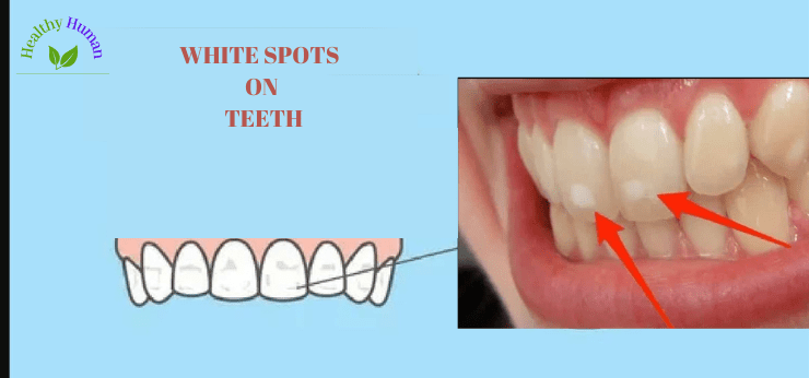 Must know causes and treatment of white spots on teeth