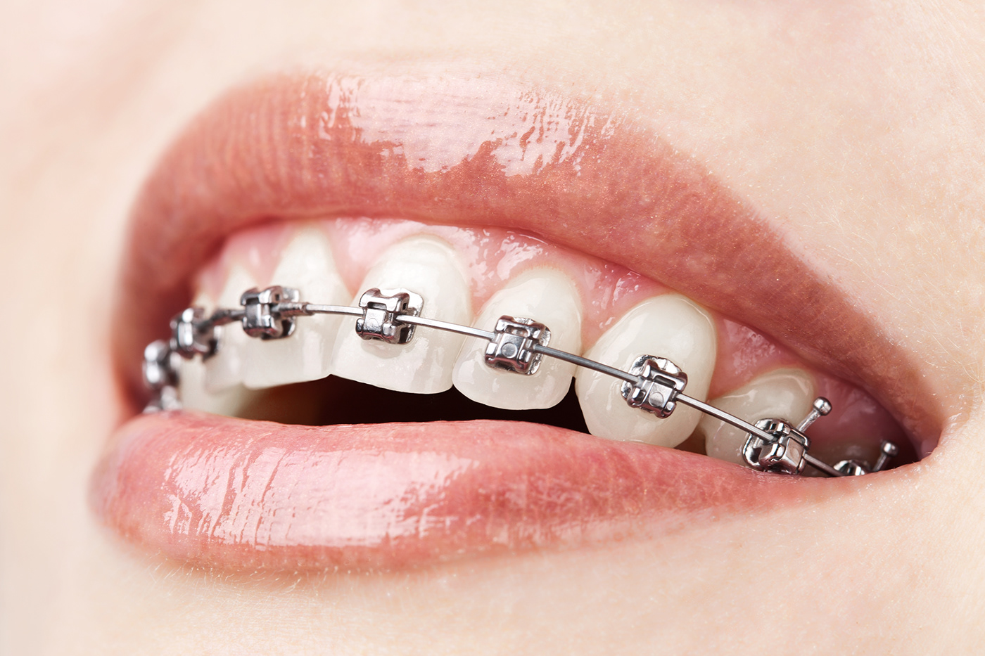The Health Benefits of Orthodontic Treatment