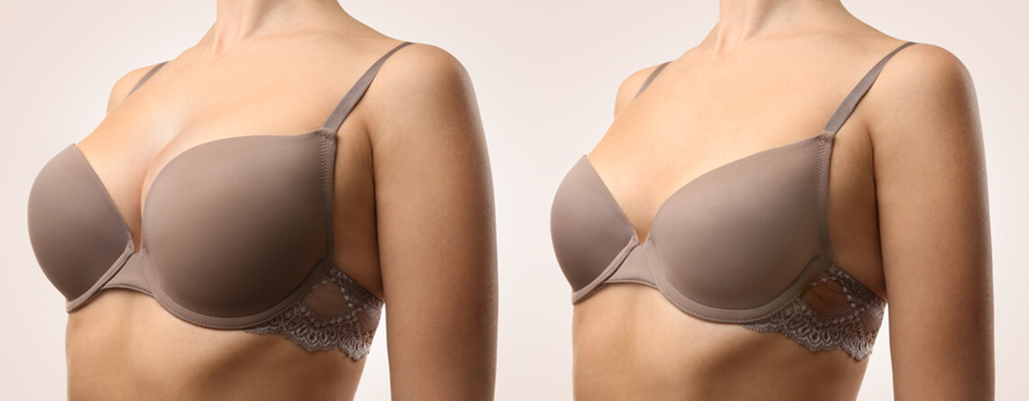 What Is The Difference Between Breast Augmentation & Implants?