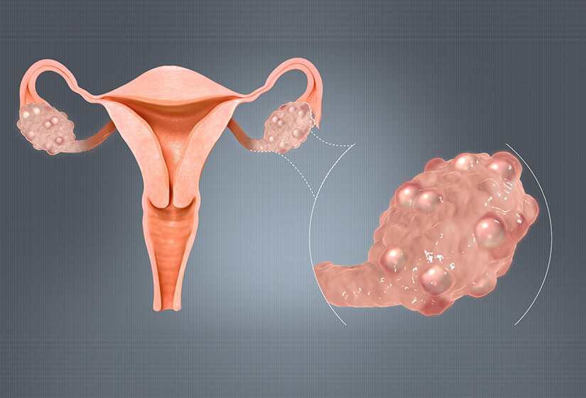 How is polycystic ovary syndrome treated? Dr Rhythm Gupta
