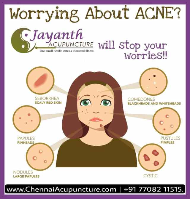 The Best Acupuncture Treatment in Chennai | Acupuncturist Near You | DoctorBest Acupuncture Treatment by Well Experienced Acupuncture Doctor in Chennai | Jayanth Acupuncture Clinic | Certified Zhu's Scalp Acupuncturist | IVF IUI Support Fertility Acupuncture