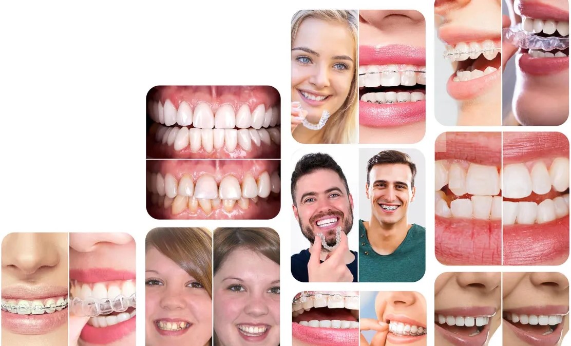 Aligners Fit: Invisalign Treatment for Your Perfect Smile