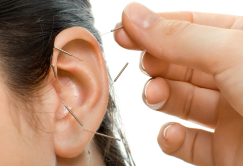 Revitalize Yourself with Auricular Acupuncture Treatment at West Island Clinic | TheAmberPost