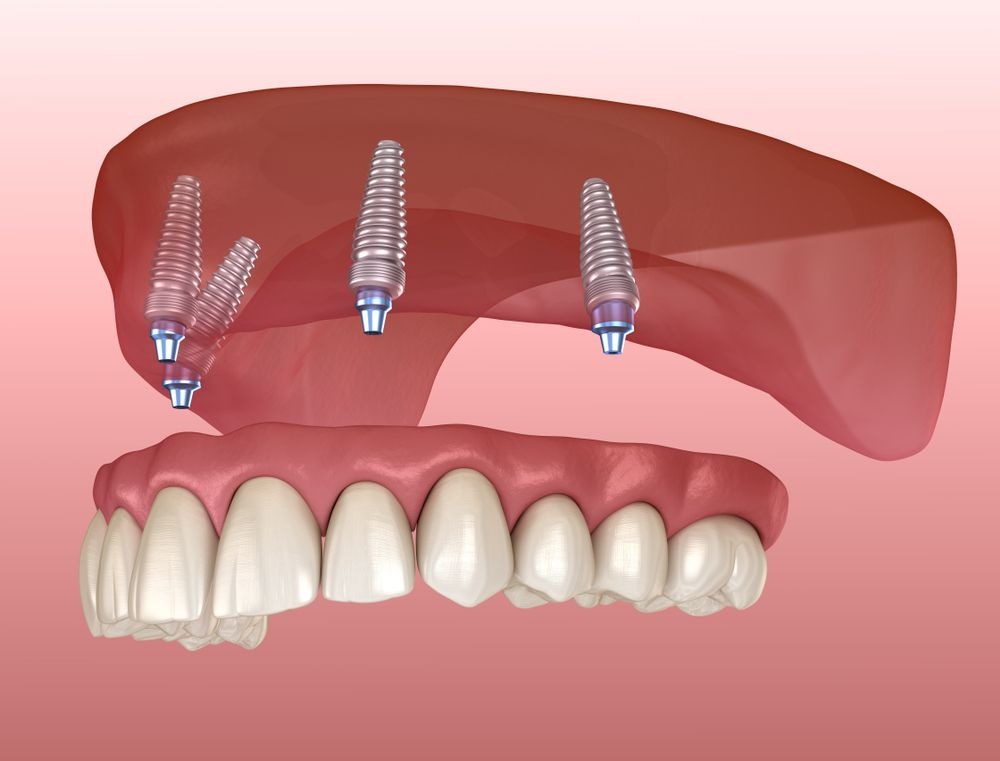 8 Reasons Why People Choose All-on-4 Dental Implants – Telegraph