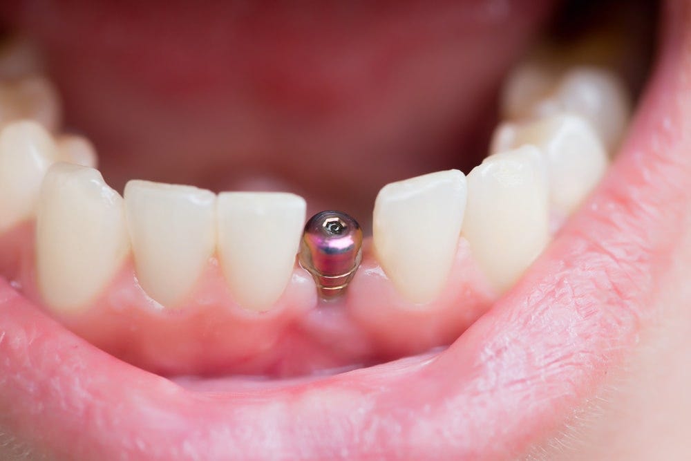 Can Dental Implants Get Infected? | by Smilewelldentistry Info | Apr, 2024 | Medium