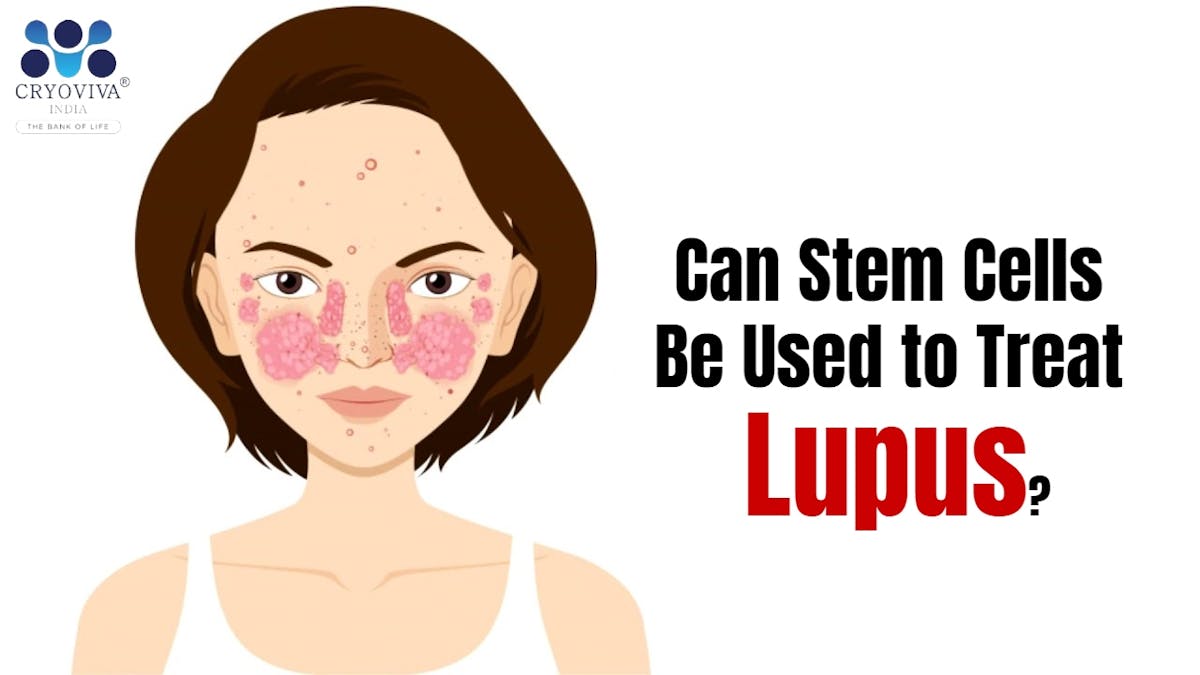 Can Stem Cells Be Used to Treat Lupus?
