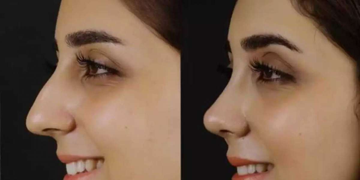 Best Doctors in Dubai Specializing in Nasal Septum Correction