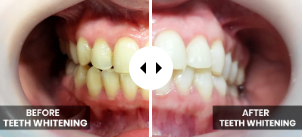 Teeth Whitening Services in Karachi | The Dental Clinic