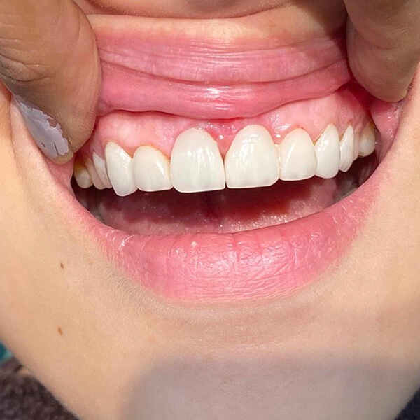 Scaling & Gum Treatment | Healthy Smile, Always