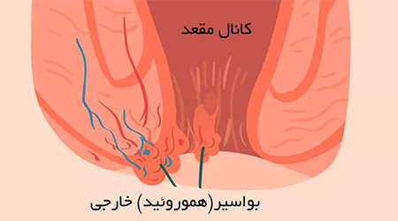 بواسیر خارجی | درمان خانگی، عفونت، قرص و پماد + 10عکس